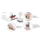 Mengkraan 200 l/min 1 x DSP 40